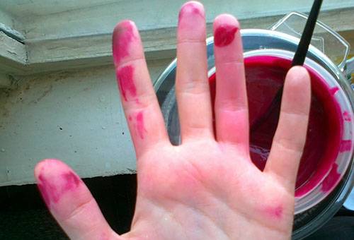 Taches de fucorcine sur la main