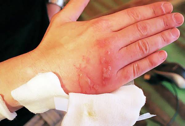 Brûlure chimique sous la main