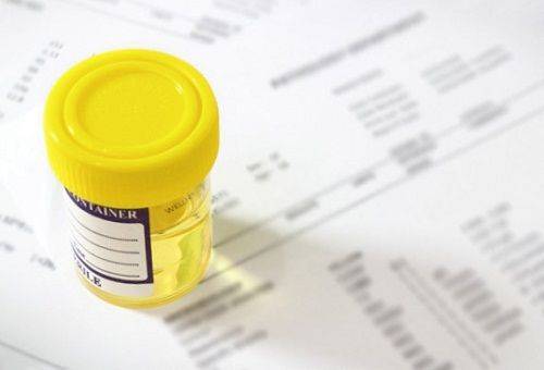 urine dans un récipient pour analyse