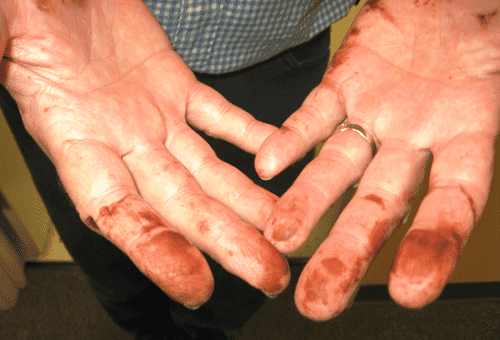 taches de permanganate de potassium sur les mains