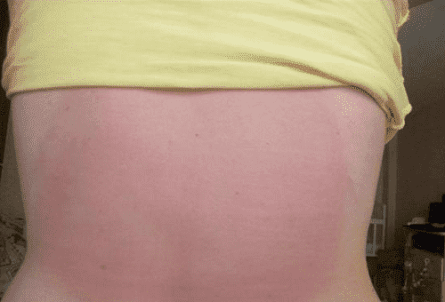 brûlure sur la peau à cause de la pommade Finalgon