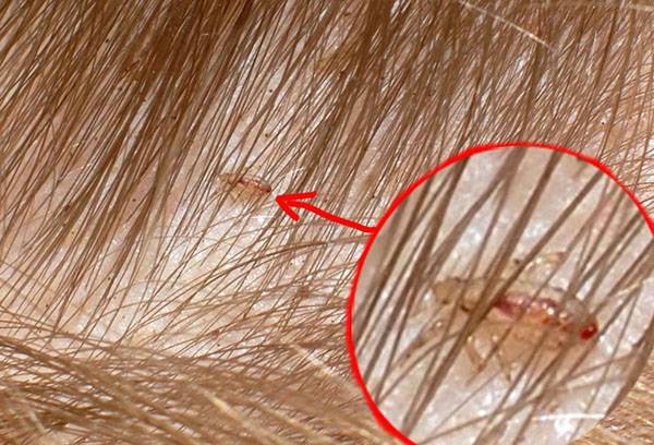 Les poux dans les cheveux