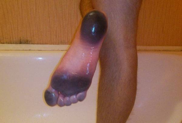 Pied taché par les chaussures