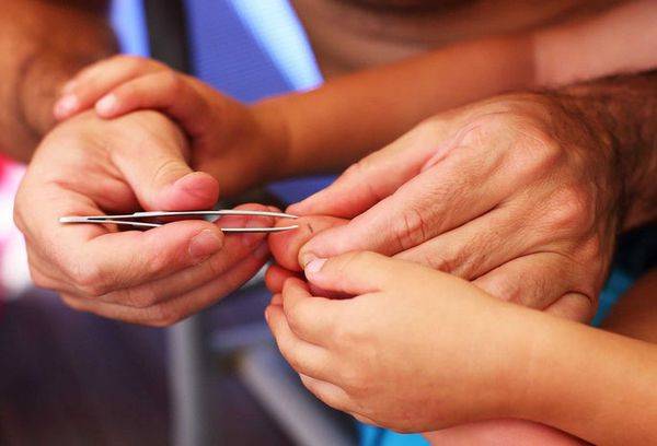 Retirer une écharde avec une pince à épiler