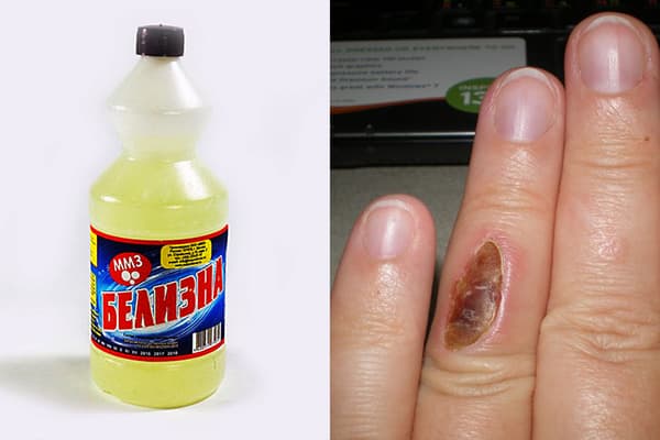 Brûlure au doigt due à la blancheur