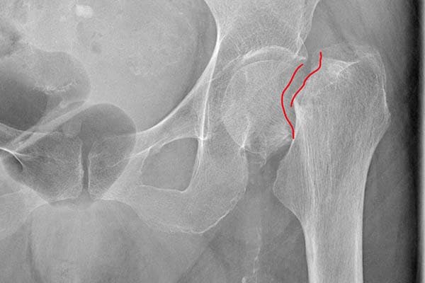 Fracture du col fémoral