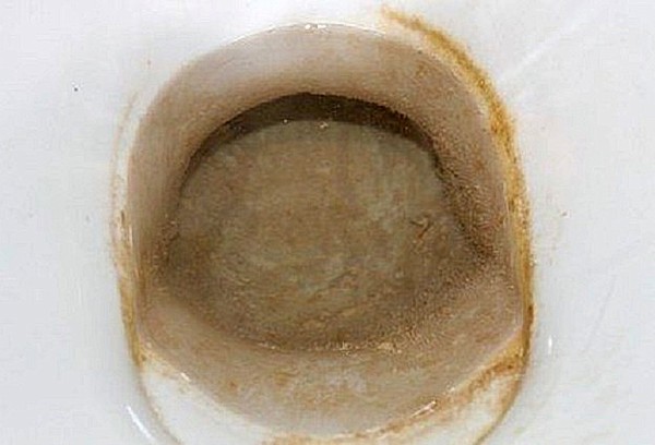 Alcalis avec calculs urinaires dans les toilettes